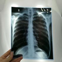 Medical film inkjet blue dry CT DR CR dental fracture X-ray radiology printed film