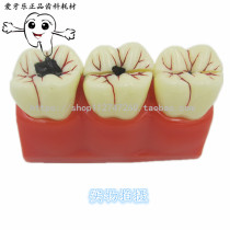 Dental dental dental caries evolution model quadruple caries decomposition model patient communication model