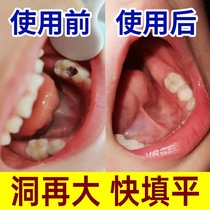 Regenerated silicon tooth decay cleaning wormtooth tooth tooth tooth cave repair