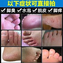 Treatment in addition to foot odor foot itch blisters peeling itching erosive exfoliation foot sweat