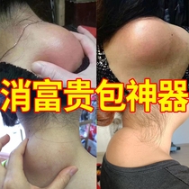 Eliminate rich bag eliminate physiotherapy neck bulge bag neck shoulder Huoxue Tongluo cervical spondylosis special patch