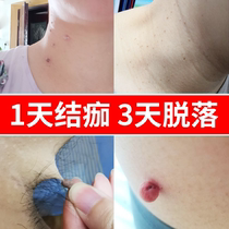  A special medicine to remove monkey meat pelicans to remove small molasses on the neck moles moles moles moles ointment artifact