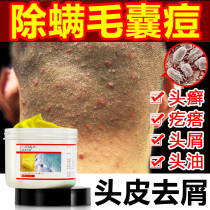 Sulphur shampoo compound anti-oil and anti-itching sterilization seborrheic scalp pox sulfur shampoo cream Shanghai