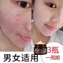 Pox-removing artifact ointment facial mites face skin care products with acne mites on the back of acne mites