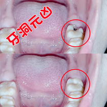 Say farewell to tooth cavities tooth holes in black tooth decay tooth cavity repair the tooth hole to repair the tooth