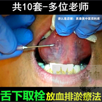 Professor Du Song under the tongue to put up blood drainage bolted Ji Hongwei Zhang Meng Chao to take down the bolted video video (for a total of 10 sets)