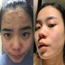 (Watsons brush acid to make pores disappear) Dont squeeze ~ Let me discharge dirt ~ Clean facial garbage