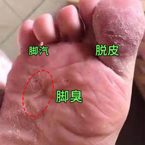 (3 days foot steam gone)Tongjitang-cool foot ning antibacterial set Specializing in foot steam farewell to foot itch foot odor peeling