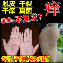 Cure peeling of hands feet feet dry soles cracking toes blisters itchy gas molting skin antibacterial and antipruritic cream