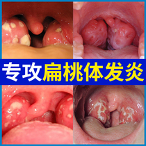 Inflammation of the tonsils swelling of the throat hypertrophy swelling phlegm foreign body sensation medicine throat cough paste dry itchy throat spray