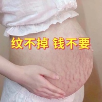 (Benevolence and ingenuity) Postpartum lactation pregnant women breastfeeding can be used obesity scar Acne Repair buy 3 get 2