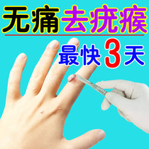Wart net meat a touch of worry-free removal of warts common warts flat filamentous wart spines pimples pimples antibacterial liquid