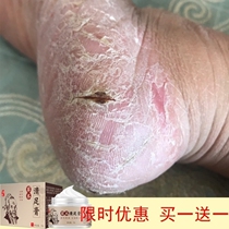 Shu Tuo herbal foot cream Hand and foot moss Itchy skin External care Beriberi ointment Chapped cream