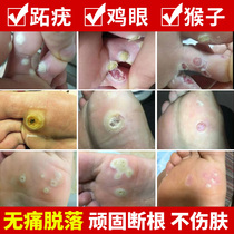 Plantar wart cream Wart seed Yug net paste root removal thorn monkey chicken eye toe removal Yuling treatment of foot meat thorn special medicine