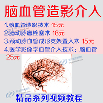 Cerebral vascular interventional angiography Technical carotid angioplasty stent implanted surgical aneurysm embolism image