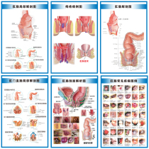 Common anorectal hemorrhoids disease legend wall sticker anorectal Anatomy hospital wall chart advertising poster