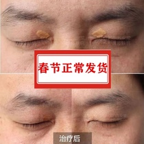 Eyelid special herbal yellow tumor round ointment repair face yellow warts medicine remove eyelid macular tumor eliminate eye removal Kang