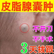 Sebaceous gland cysts plasters remove the pink pimples jam the clogged acne Acne Fire furuncle Tubal Cupping the Pussy Pussy