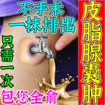 Sebaceous cyst cream removing hypodermic powdery tumor sebaceous gland cyst acne fire boil pulling poison pulling pus cream acne acne ointment
