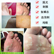 Removal of plantar fascia treatment of virus removal of hand and foot common removal of toe removal of flesh thorn monkey armor Zhou blood cell thorn