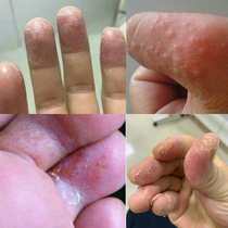 Finger cracking heel anti-cracking hand sole foot skin peeling hand peeling cream hand cream repair seasonal