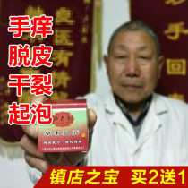 Hand molting hands small blisters dry fingers itching peeling itching palms old man Lu herbal cream