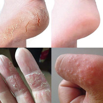 Many people have used their hands to peel dry itchy small blisters dry hands and feet stop itching seasonal