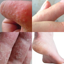 Hand cracking repair cream Hands and feet Palms and soles of feet Peeling crack prevention Dry chapped heel artifact Crack healing cream