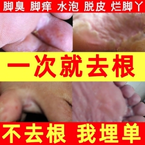 New beriberi cream Foot bath sweat foot special Chinese medicine foot odor peeling antiperspirant Imported elimination buster spray sterilization