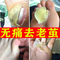 (A drop of removing calluses) Yunnan herbal calluses remove softeners to remove foot dead skin thick cocoons to corns wart