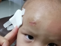 Yue Ke Li yeast recombinant scar Vik Li silicone gel postpartum childrens scar precipitation acne mark anti-pregnancy pattern hyperplasia