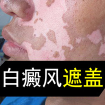 Vitiligo leukoplakia skin color masking liquid topical durable spot artifact face arm Waterproof Concealer Pen to buy