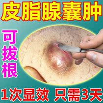 Sebaceous gland cyst cream removes subcutaneous cysts ectopic lips secrete exuberant pulling plaster to treat acne artifacts