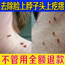 Get rid of thorn scorpion sarcoma removal cream to remove small meat particles on the monkeys neck adenocarcinoma skin fat medicine Meat mole Convex mole artifact
