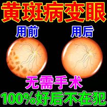 Macular degeneration eye drops(no surgery required)Middle-aged and elderly vision loss Blurred deformation Dark shadow macula