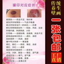 Cupping printing corresponding to symptoms wall chart Chinese medicine health pictures advertising propaganda painting Meridian decoration painting beauty salon poster