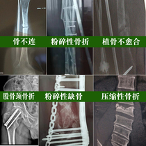 Dong herbal fracture fracture healing continued tendon bone joint bone powder comminuted fracture ligament strain callus growth external application