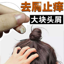 Drain itching oil control shampoo desite anti-mite large dandruff artifact serious medicine for men and women